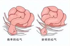 疝气是什么？