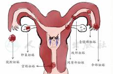 什么是异位妊娠？